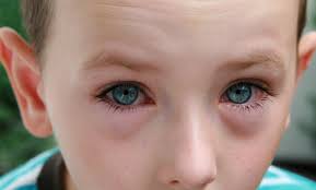 allergy conjunctivitis